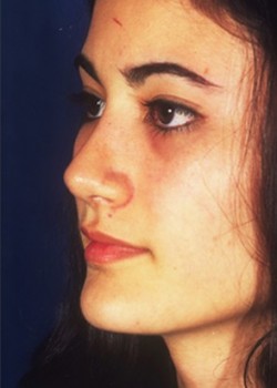 Rhinoplasty