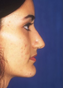 Before Image: Rhinoplasty - right-side