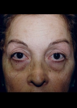 Blepharoplasty