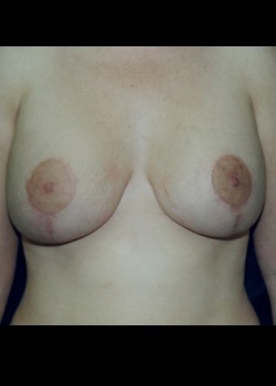 Breast Augmentation with Lift – Case 1