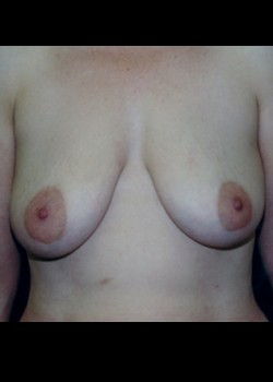 Breast Augmentation with Lift