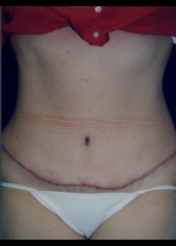 Abdominoplasty