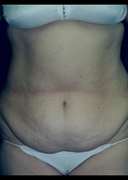 Abdominoplasty