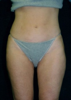 Liposuction – Case 1