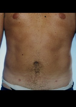 Male Liposuction