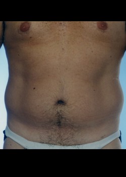 Male Liposuction – Case 1