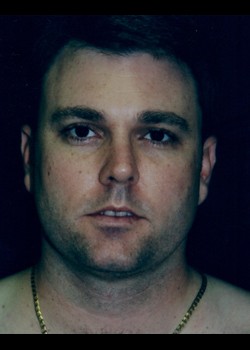 After Image: Male Liposuction - front