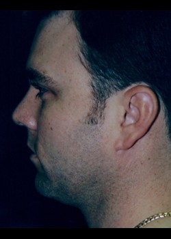 After Image: Male Liposuction - other