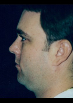 Before Image: Male Liposuction - other