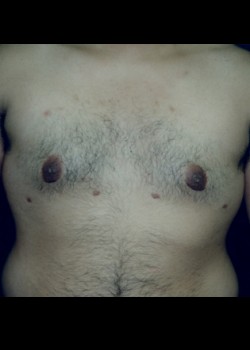 Gynecomastia