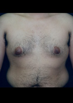 Gynecomastia