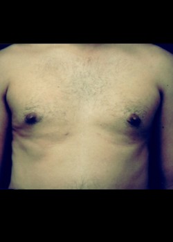 Gynecomastia