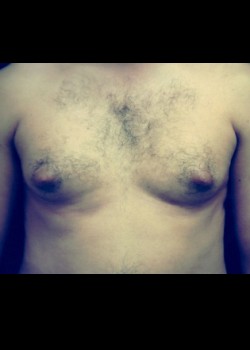 Gynecomastia