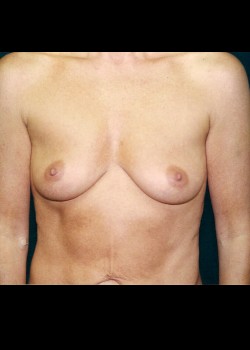 Breast Augmentation – Case 4