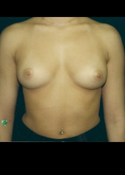 Before Image: Breast Augmentation - front