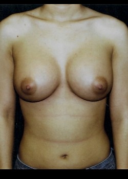Breast Augmentation – Case 8