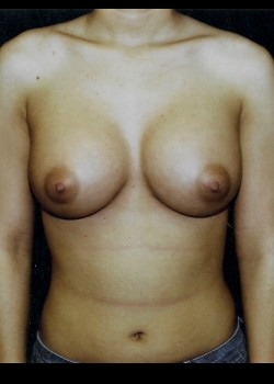 After Image: Breast Augmentation - front