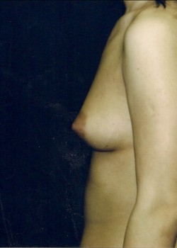 Before Image: Breast Augmentation - other