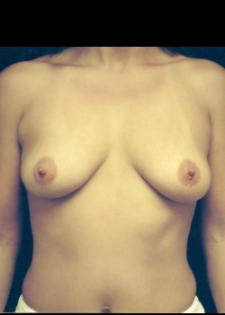 Breast Augmentation – Case 10
