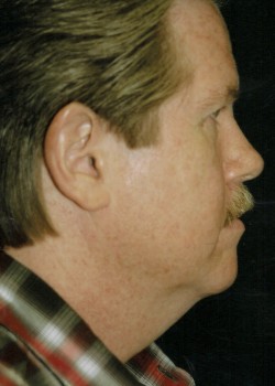 Before Image: Face Lift - other