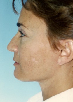 After Image: Face Lift - other