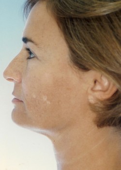 Before Image: Face Lift - other