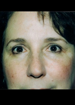 Blepharoplasty