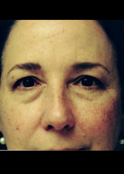 Blepharoplasty