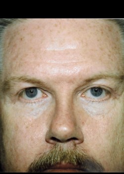 Male Blepharoplasty