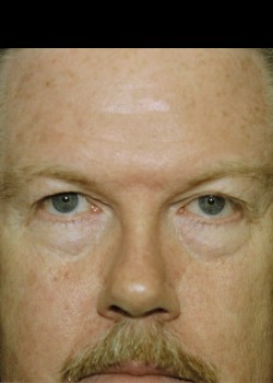 Male Blepharoplasty